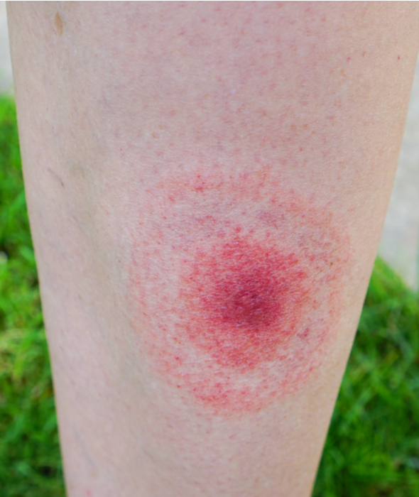 erythema migrans (EM) rash looks like a bullseye, a symptom of Lyme